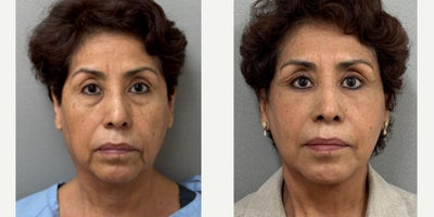 55-64 year old woman treated with Deep Plane Facelift, lower blepharoplasty and buccal fat removal - 64 yo woman s/p Deep plane facelift/ necklift, buccal fat removal, and lower blepharoplasty with skin pinch and canthopexy performed in our on site AAAA certified operating suite under twilight sedation