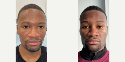 18-24 year old man treated with Chin Filler, Cheek Fillers - When this patient came to my NYC office, he had one goal: to feel confident in his skinespecially when connecting with others and walking into any room with presence. He already had strong features, but they just werent popping the way he wanted. So I did what I do best: took what was there and turned up the volumewith precision, balance, and bold sculpting.Heres what I treated to bring his vision to life: Chin  Enhanced projection for strength and symmetry Jawline  Sharpened and chiseled for that unmistakably masculine edge Cheeks  Contoured for definition and structure Under Eyes  Smoothed and filled for a rested, powerful look Nasolabial Folds  Softened for a youthful, seamless finishThis isnt a one-size-fits-all approach. Its strategic artistrycustomized to amplify his unique features while keeping the results natural and effortlessly sculpted.He walked out with a face thats not only refined and structuredbut one that now matches how he feels on the inside. And trust me, hes loving the way people are noticing.If youre ready to look sharper, feel stronger, and turn heads with confidence: