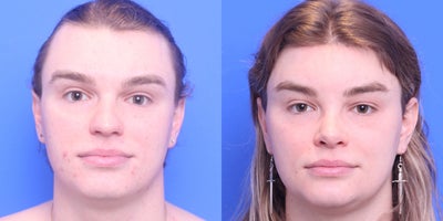 25-34 year old transgender woman treated with Facial Feminization Surgery - browlift, brow bone reduction, hairline advancement, rhinoplasty, AFG-cheeks, mandible/chin contouring, sliding genioplasty, submental liposuction
