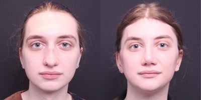 18-24 year old transgender woman treated with Facial Feminization Surgery - browlift, brow bone reduction, hairline advancement, rhinoplasty, AFG-cheeks, NLFs, thyroplasty, mandible/chin contouring, sliding genioplasty, submental liposuction