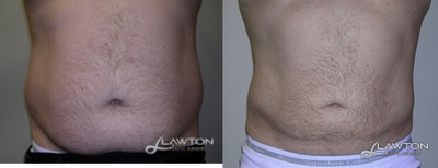 35-44 year old man treated with Liposculpture - 35-44 year old man treated with Liposculpture