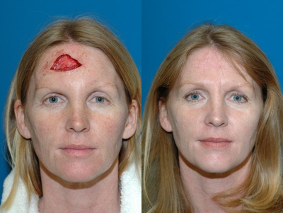 Forhead reconstruction after Mohs surgery - 
	45 year old woman has a basal cell carcinoma on forehead treated with Mohs surgery. The forehead defect was repaired with local flaps in single procedure. Post op photo taken 6 months after surgery.
