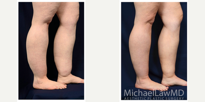 25-34 year old woman treated with Calf Reduction - Lower leg liposcution