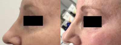 55-64 year old woman treated with TempSure Envi - Treated with TempSure Envi for the full face
