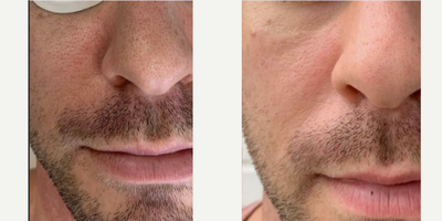 25-34 year old man treated with Lux 1540 - Look at the improvement in pores after just one treatment with our fractional non-ablative laser.