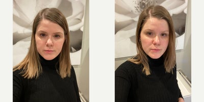 25-34 year old woman treated with HydraFacial - from dull to glowing!