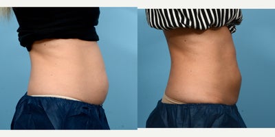 25-34 year old woman treated with Cryolipolysis - 1 session of CoolSculpting for the abdomen.