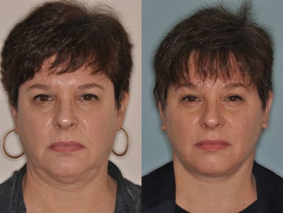Facelift - Facelift before and after.