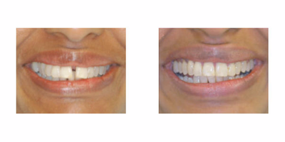 Gaps between teeth treated with Clear Braces - 50 year old woman concerned about gaps between teeth. Patient was treated with clear braces. Treatment time was 5 months followed by bonded retainers.