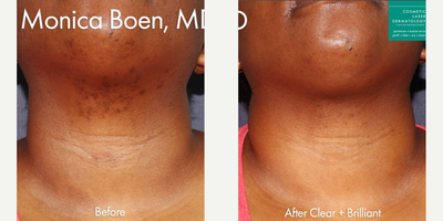 Woman treated with Clear and Brilliant - Clear + Brilliant laser to treat brown spots on chin and neck by Dr. Boen