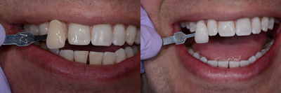 Zoom Whitening - The patient was given 4 Ibuprofen prior to the whitening treatment. Upper and lower full arch impressions were taken in order for the patient to have take-home trays.