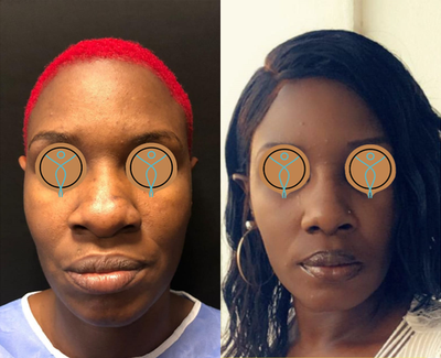 35-44 year old woman treated with African American Rhinoplasty - 