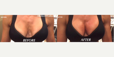 Woman treated with Vampire Breast Lift - Woman treated with Vampire Breast Lift