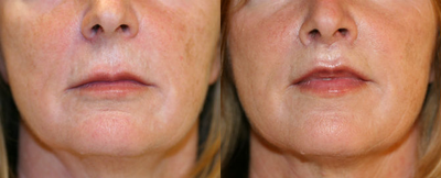 Lip Lift - 
	before and one year after lip lift and anguloplasty. No augmentation, no injectable filler, no implant.
