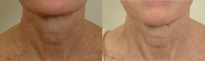 Pearl Laser Treatment - Pearl laser neck-one treatment