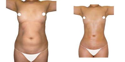 35-44 year old woman treated with Liposculpture - Liposculpture consists of eliminating fat from different body segments through the use of technology, passing the fat from a solid state to a liquid state.Generating very natural results in the characteristics of the skin, harmony and proportion in the corporal forms.It is not a slimming method, it is a method of molding, however as a result of the intervention you will achieve to reduce measurements and lose weight considerably.The areas to be intervened can be arms, abdomen, back, thighs, buttocks, among others, after an assessment by the specialist.