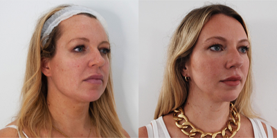 25-34 year old woman treated with Silhouette Soft - Silhouette Soft Thread Lift performed