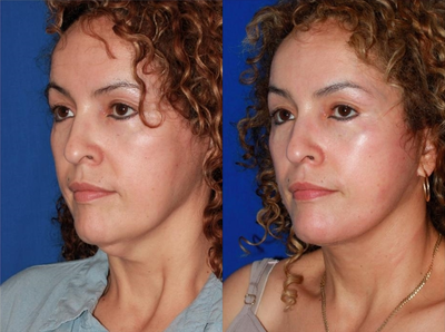 35-44 year old woman treated with Facelift Revision - This patient recently underwent a facelift with another doctor. However, she was dissatisfied with the lack of improvement in the neck. Secondary face and neck lift was performed to restore youthful neck contour.