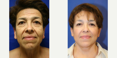 Brow Lift - This is 61 year old female.  She was not happy with the appearance of her face or neck.  She underwent a face lift, neck lift, brow lift, upper and lower blepharoplasty and earlobe reduction. - Individual Results May Vary