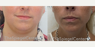 25-34 year old transgender woman treated with Jaw Surgery - 25-34 year old transgender woman treated with Jaw Surgery