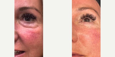 Woman treated with Sylfirm X - This cutting-edge technology combines the benefits of traditional micro-needling with the skin-tightening effects of Radiofrequency, helping you achieve a firmer, smoother, and more radiant complexion.