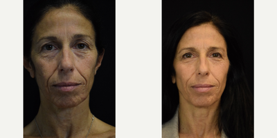 55-64 year old woman treated with Bellafill - Bellafill