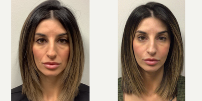 25-34 year old woman treated with Cheek Augmentation - Patient was treated with the RHA Collection filler line to add volume back to her medial cheeks and nasolabial folds.