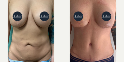 45-54 year old woman treated with Breast Implants, Breast Implant Revision, Breast Lift with Implants, Tummy Tuck, Liposuction R - A 45-year-old woman, who previously underwent a breast lift with implants and abdominal liposuction, presented five years later with capsular contracture, breast sagging, and multiple abdominal irregularities. She underwent a revision breast lift using the inverted T (anchor) technique, breast implant exchange, revision liposuction, and a tummy tuck (abdominoplasty).
