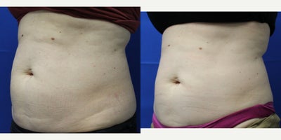 35-44 year old woman treated with CoolSculpting Elite - 44 year old woman treated with CoolSculpting Elite