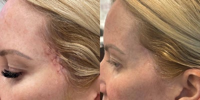 52 year old woman treated with Excel V, Mohs Surgery - This 52-year-old patient underwent a MOHS procedure on her left temple to address a skin concern, followed by two Excel V laser treatments to improve the appearance of the surgical scar. The before photo shows the incision site shortly after the MOHS procedure, with visible redness and texture. After the first Excel V treatment, the area looks calmer, with reduced redness and smoother skin. By the second treatment, the scar has significantly faded, blending seamlessly with the surrounding skin. This combination of treatments showcases how advanced dermatologic care can support healing and restore confidence.