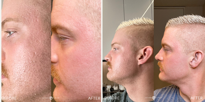 Man treated with Laser Peel - Improved scarring with Laser plus Chemical Peel