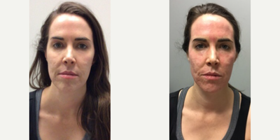 Woman treated with Secret RF - Woman treated with Secret RF, shown immediately after the treatment.