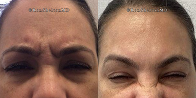 45-54 year old woman treated with Jeuveau - 3 weeks post Jeuveau on glabella, total elimination of frowning