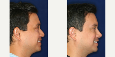 Permanent Non-surgical Rhinoplasty - Obscuring hump. Refining and accentuating the tip.