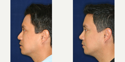 Permanent Non-surgical Rhinoplasty - Obscuring hump. Refining and accentuating the tip.