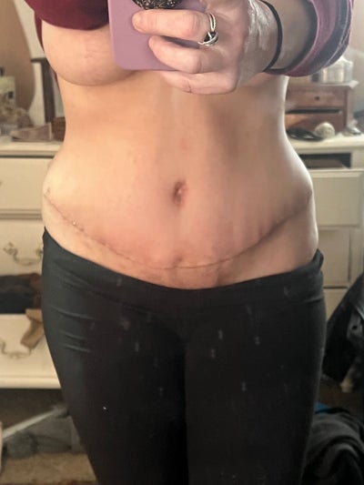 Liposuction Creates A Waist For Tummy Tuck Patients Case #206