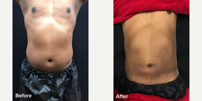 35-44 year old man treated with Tickle Lipo - We can provide Tickle Liposuction from the comfort of our St. Louis medical cosmetic and laser center. This state-of-the-art liposuction method can remove stubborn fat in a way that maintains patient comfort, reduces swelling and recovery time, and still provides outstanding results.