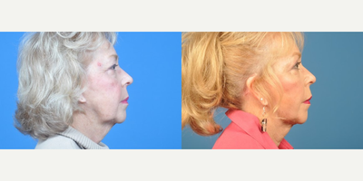 Woman treated with Facelift - Woman treated with Facelift