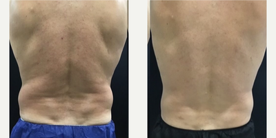 45-54 year old man treated with CoolSculpting, truSculpt iD - 1 round of Coolsculpting followed with TruSculpt iD to help eliminate flanks and tighten the skin through RF.