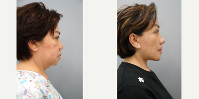 Facelift, Necklift, Rhinoplasty, Genioplasty, Browlift - Anti-aging- Deep Plane Facelift- Platysmal Necklift- Sub-Brow liftRhinoplasty - 100% Rib Cartilage Rhinoplasty- Mid-face AugmentationGenioplastyPerformed by Dr. Myung Ju Lee of VIP Plastic Surgery Korea