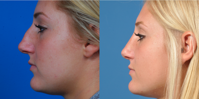 18-24 year old woman treated with Septorhinoplasty - Patient unhappy with cosmetic appearance of nose, as well as having a deviated septum. Patient underwent septorhinoplasty.