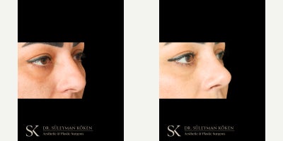 35-44 year old woman treated with Breast Implants, Breast Augmentation, Rhinoplasty - Breast Augmentation with 400cc High Profile Implants + Rhinoplasty