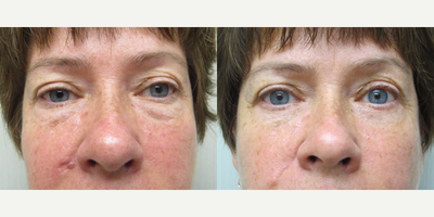 35-44 year old woman treated with Eyelid Surgery - Patient had her lower eyelids rejuvenated (Blepharoplasty)