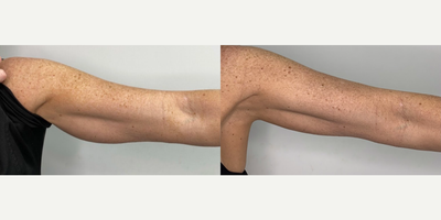 35-44 year old woman treated with Mesotherapy - Liquid Lipo Shots