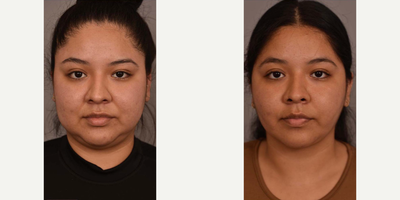 Woman treated with Buccal Fat Removal - Woman treated with Buccal Fat Removal, Chin/Neck Liposuction, and Cheek Liposution.