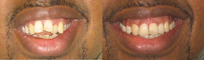 Braces: correction of openbite and dental crowding - 
	A large openbite (inability to touch the front teeth) and severe dental crowding corrected with braces
