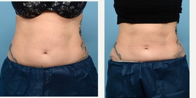 45-54 year old woman treated with CoolSculpting, Cryolipolysis - Patient was treated with one session of CoolSculpting on the abdomen and flanks. She loves the better fit of her clothes and more toned appearance of her mid-section following the body contouring treatment.