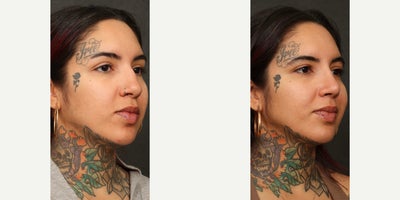 25-34 year old woman treated with Rhinoplasty - female rhinoplasty