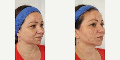 35-44 year old woman treated with Thread Lift, Skin Tightening, Skin Rejuvenation, NovaThreads, Nonsurgical Facelift - Thread Lift
