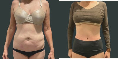 55-64 year old woman treated with Tummy Tuck, Liposuction - This patient selected an extended tummy tuck combined with liposuction throughout her abdomen and flanks to create more balanced and proportional results.